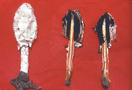 Podaxis carcinomalis